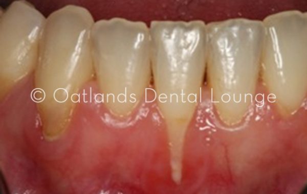 Before - Oatlands Dental Lounge