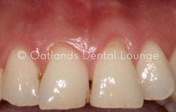 Before - Oatlands Dental Lounge