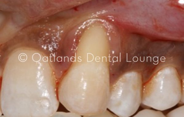 Before - Oatlands Dental Lounge