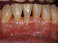 Before - Oatlands Dental Lounge