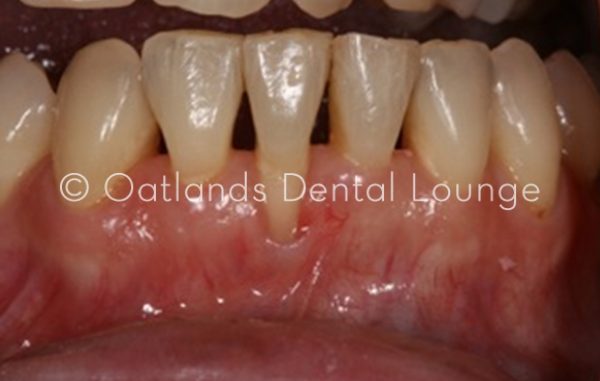 Before - Oatlands Dental Lounge