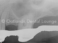 Before - Oatlands Dental Lounge