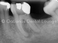 Before - Oatlands Dental Lounge