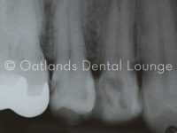 Before - Oatlands Dental Lounge
