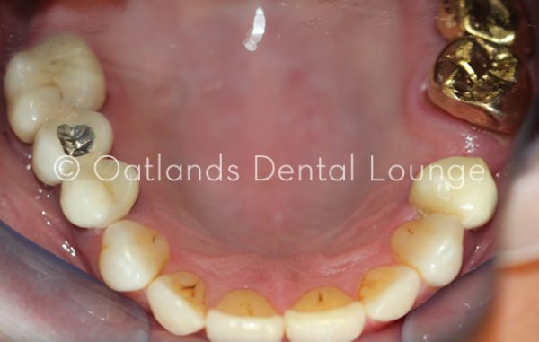 Before - Oatlands Dental Lounge