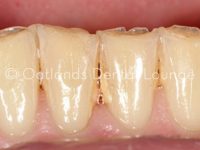 Before - Oatlands Dental Lounge