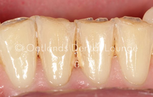 Before - Oatlands Dental Lounge