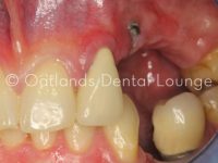 Before - Oatlands Dental Lounge