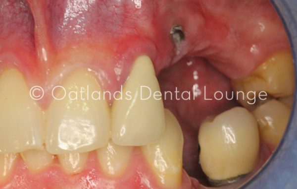 Before - Oatlands Dental Lounge