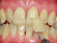 Before - Oatlands Dental Lounge