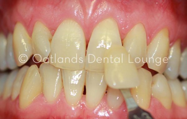 Before - Oatlands Dental Lounge