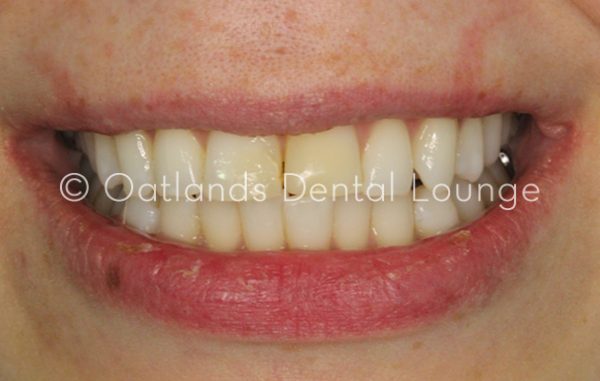 Before - Oatlands Dental Lounge