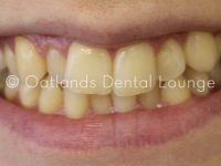 Before - Oatlands Dental Lounge