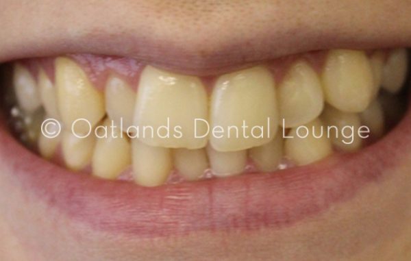 Before - Oatlands Dental Lounge
