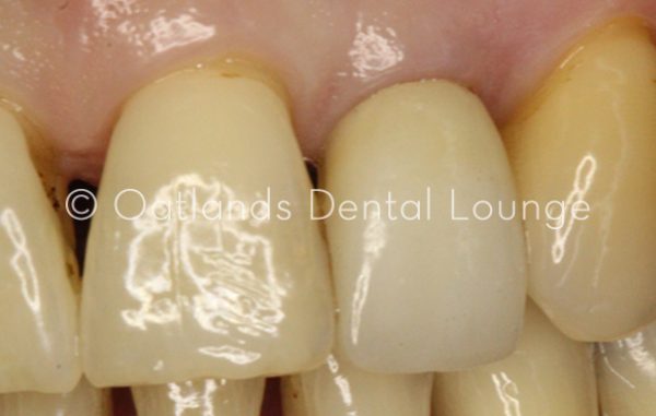 Before - Oatlands Dental Lounge