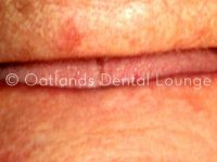 Before - Oatlands Dental Lounge
