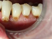 Before - Oatlands Dental Lounge