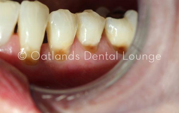Before - Oatlands Dental Lounge