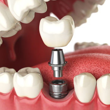 Treatment - Oatlands Dental Lounge