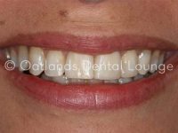 After - Oatlands Dental Lounge