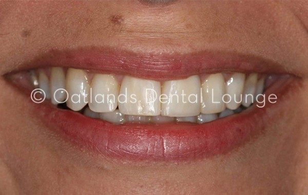 After - Oatlands Dental Lounge