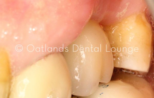 After - Oatlands Dental Lounge