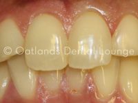 After - Oatlands Dental Lounge