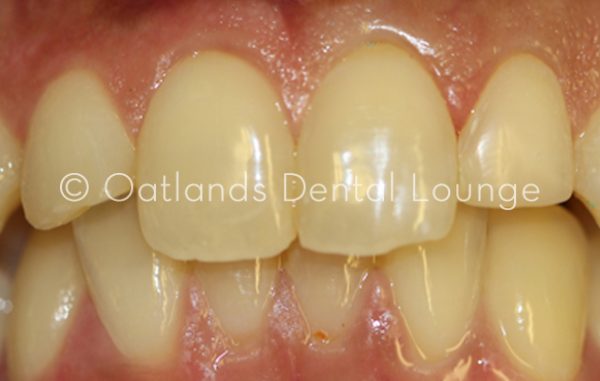 After - Oatlands Dental Lounge