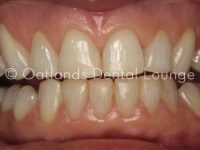After - Oatlands Dental Lounge