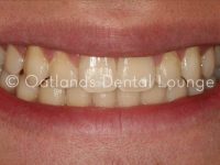 After - Oatlands Dental Lounge