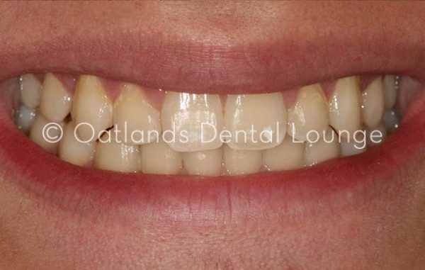 After - Oatlands Dental Lounge