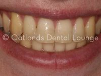 After - Oatlands Dental Lounge