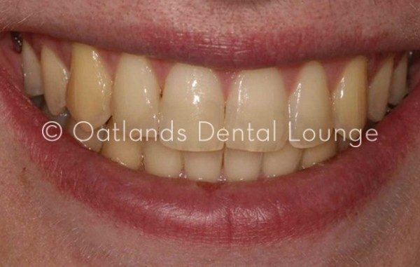 After - Oatlands Dental Lounge