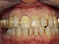 Before - Oatlands Dental Lounge