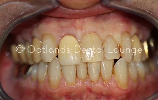 Before - Oatlands Dental Lounge