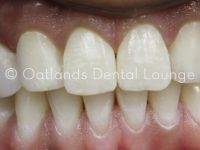 After - Oatlands Dental Lounge