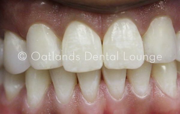 After - Oatlands Dental Lounge