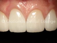 After - Oatlands Dental Lounge