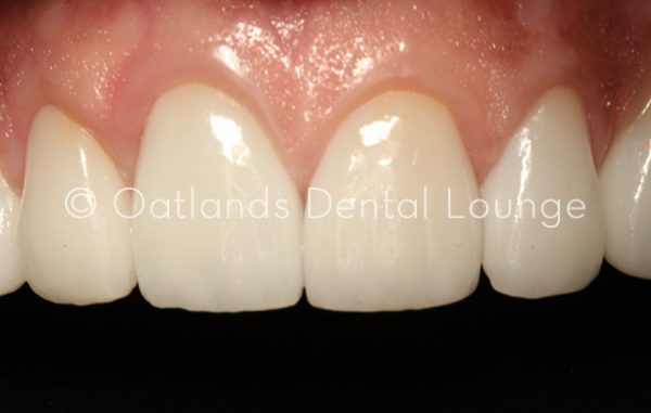 After - Oatlands Dental Lounge