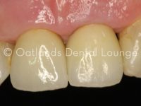 After - Oatlands Dental Lounge
