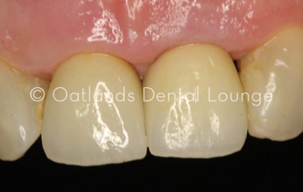 After - Oatlands Dental Lounge