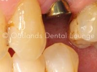 Before - Oatlands Dental Lounge