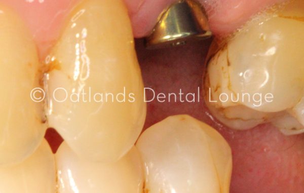 Before - Oatlands Dental Lounge