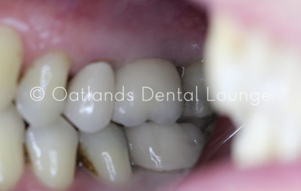 After - Oatlands Dental Lounge