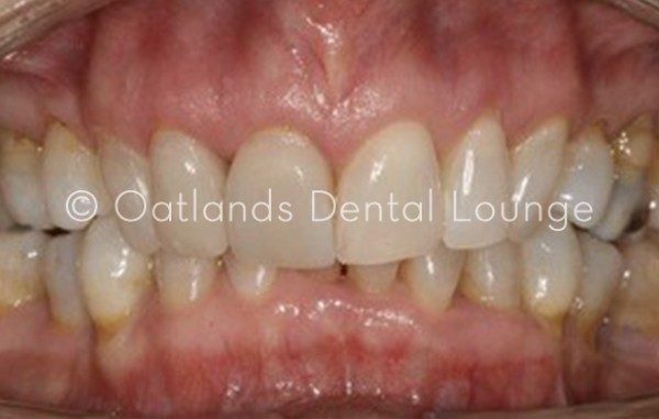 After - Oatlands Dental Lounge