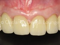 After - Oatlands Dental Lounge