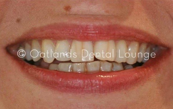Before - Oatlands Dental Lounge
