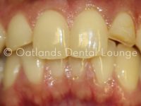 Before - Oatlands Dental Lounge