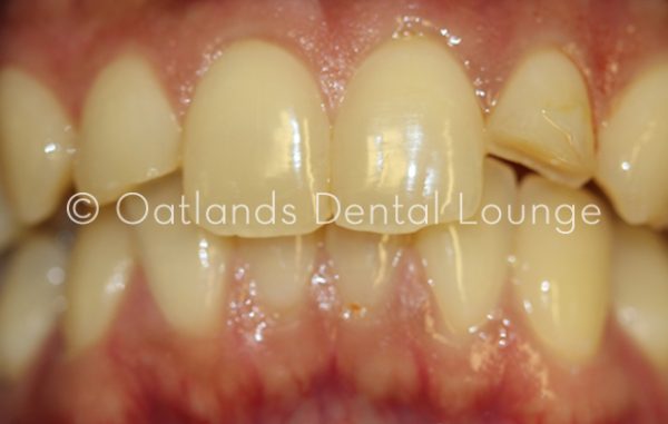 Before - Oatlands Dental Lounge