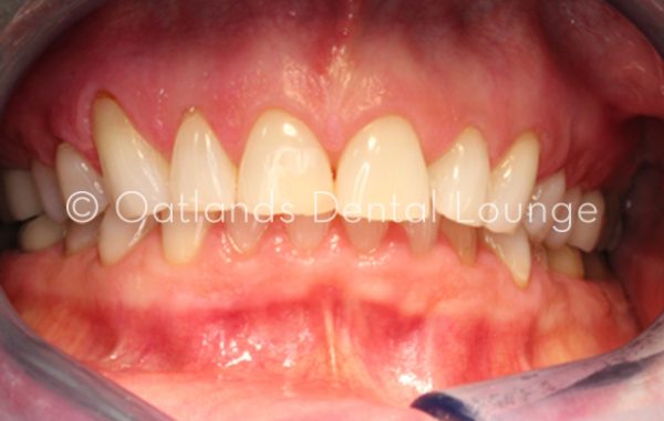 Before - Oatlands Dental Lounge